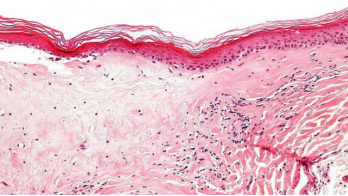 Lichen planus affecting the female genitalia: A retrospective review of patients at Mayo Clinic